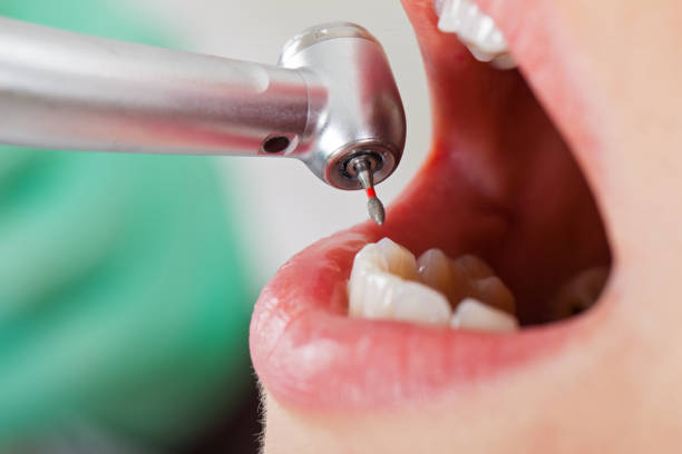 Best Root Canal Emergency Dentist  in Vidor, TX